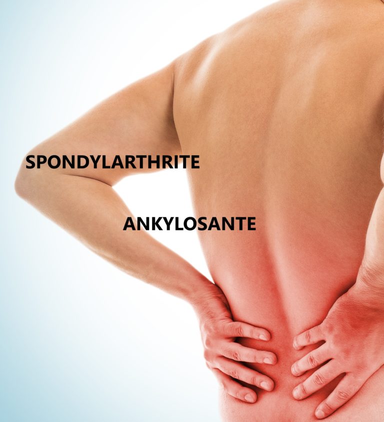 SPONDYLARTHRITE ANKYLOSANTE – Les solutions naturelles qui fonctionnent pour moi